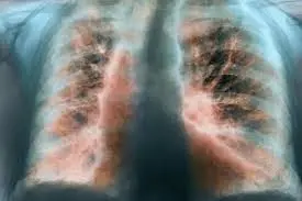 Fisetin Emerges as a Potential Game-Changer in Lung Fibrosis Treatment